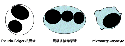 pseudo-pelger核異常 異常多核赤芽球 micromegakaryocyte