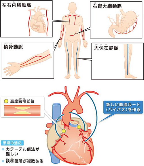 冠動脈バイパス術の画像