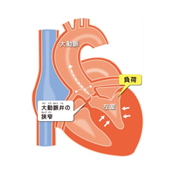 大動脈弁狭窄症の画像