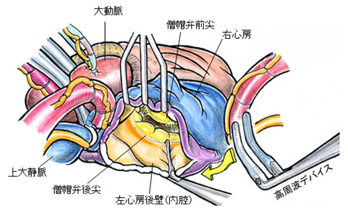 肺静脈隔離術の画像