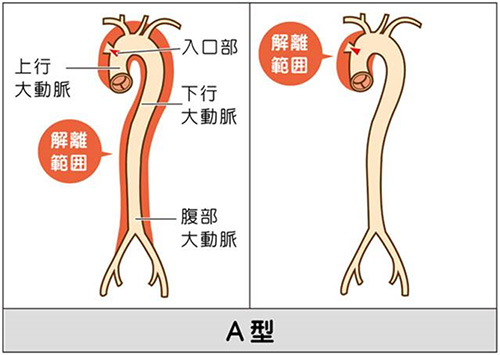大動脈解離の分類A型の画像