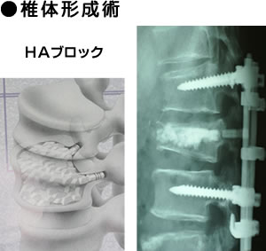 椎体形術の画像
