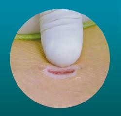 MED(Micro Endoscopic Discectomy:従来の内視鏡下椎間板切除術)の画像1