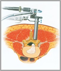 MED(Micro Endoscopic Discectomy:従来の内視鏡下椎間板切除術)画像2