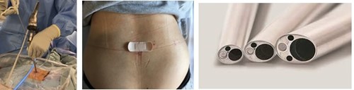 FED(Full-endoscopic discectomy: 全内視鏡下椎間板切除 旧PED)の画像