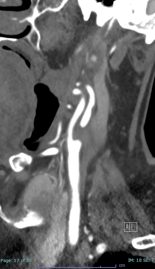 内頚動脈狭窄MPR像画像