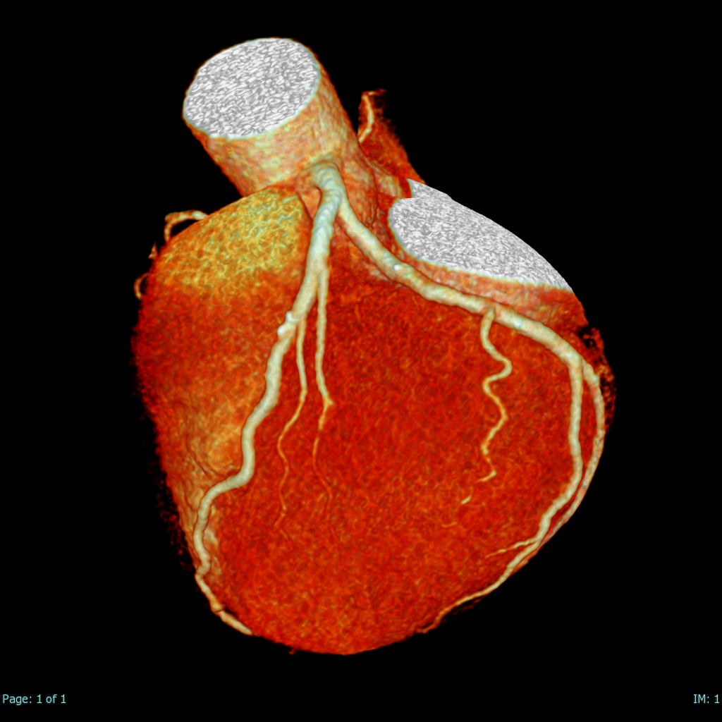 心臓ＣＴ（左冠動脈）画像