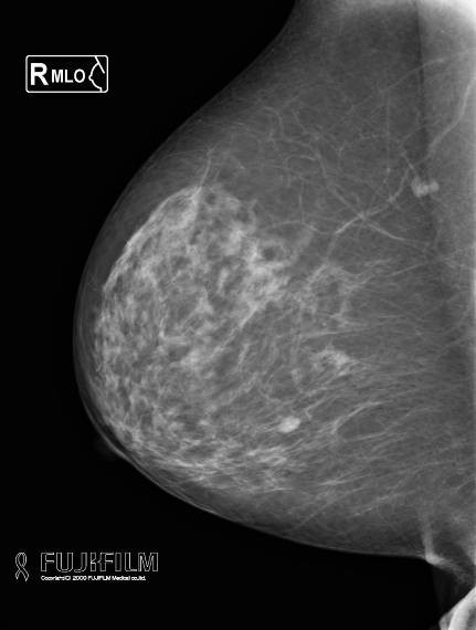 マンモグラフィ　ＭＬＯ（内外斜位）撮影画像