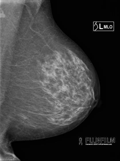 マンモグラフィ　ＭＬＯ（内外斜位）撮影画像2